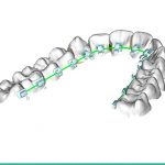 Posicionamiento de brackets