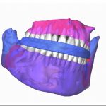 Impresión 3D de guías quirúrgicas