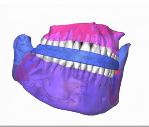 Impresión 3D de guías quirúrgicas
